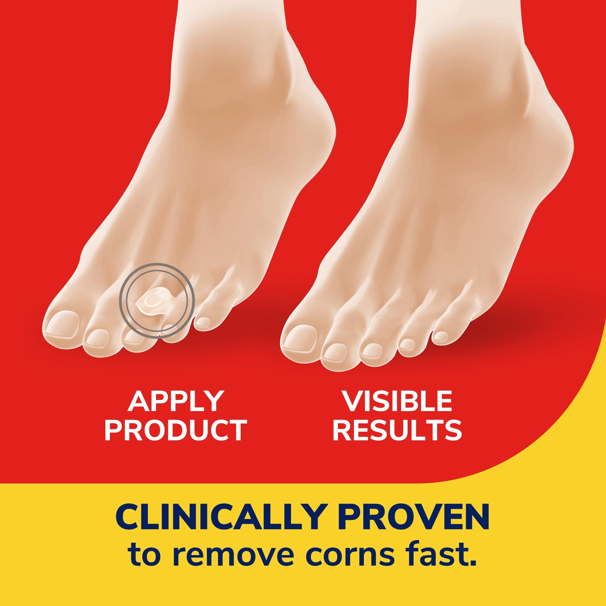 Corn Removers Seal Heal Bandage with Hydrogel Technology DrScholls