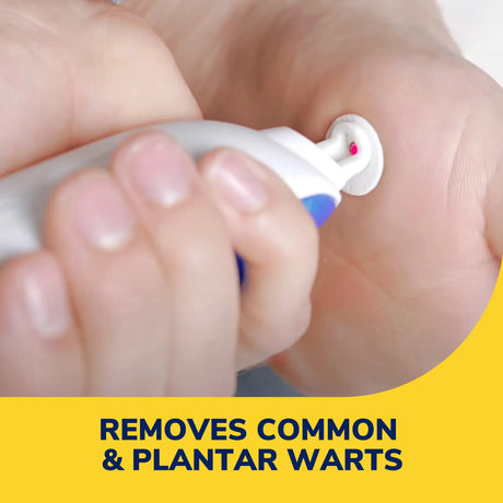 Freeze Away Max™ Wart Remover